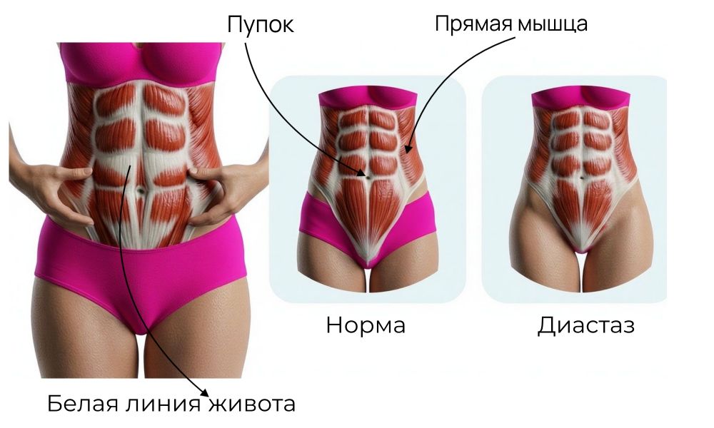 Ушивание диастаза: вернуть телу опору, а не просто «плоский живот»